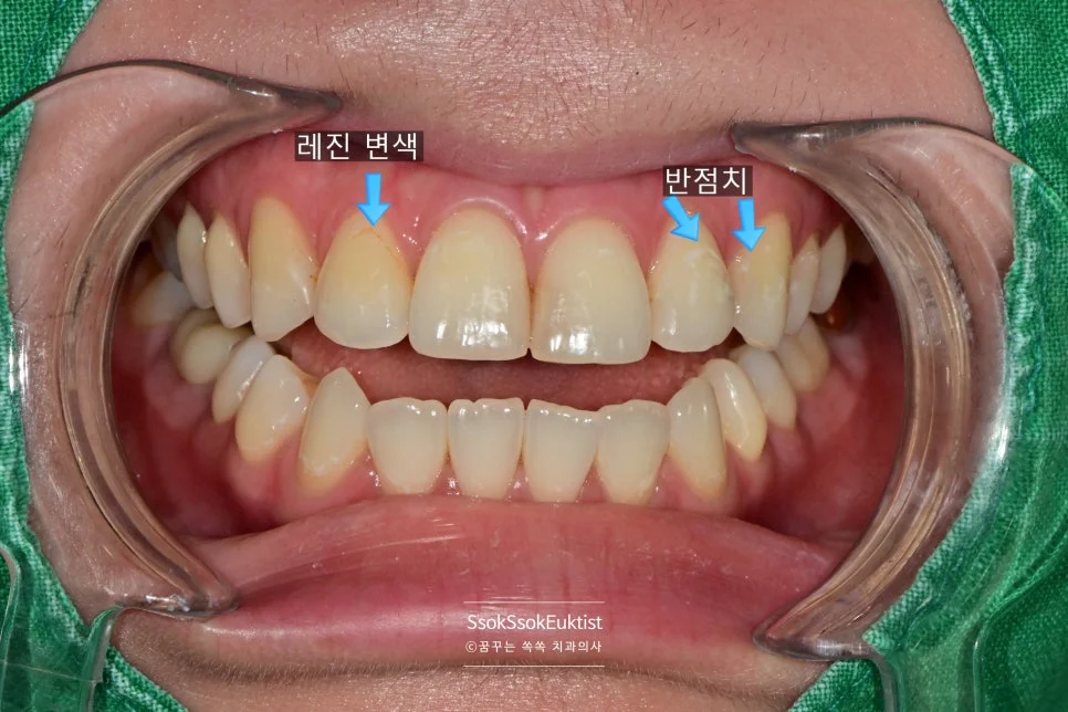 교정 후 반점치 치료 전 앞니 하얀 반점 다수 증례1