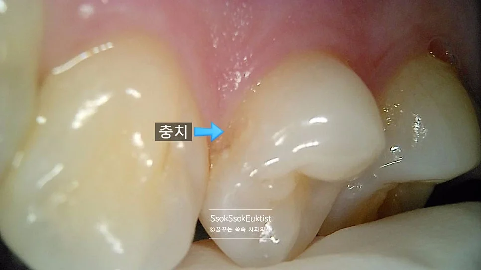 법랑질 충치 클로즈업 육안으로 잘 보이지 않는 초기 충치