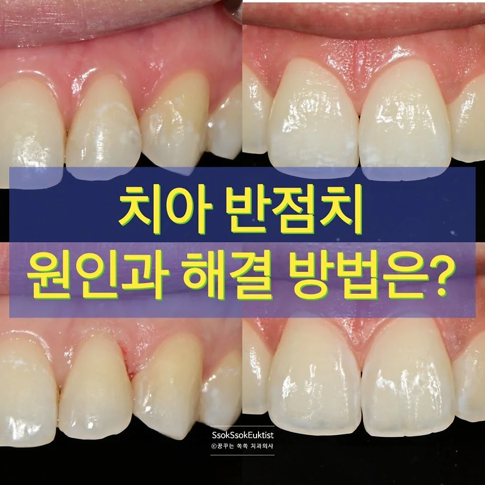 반점치 치료 전 앞니 표면 하얀 반점 모습