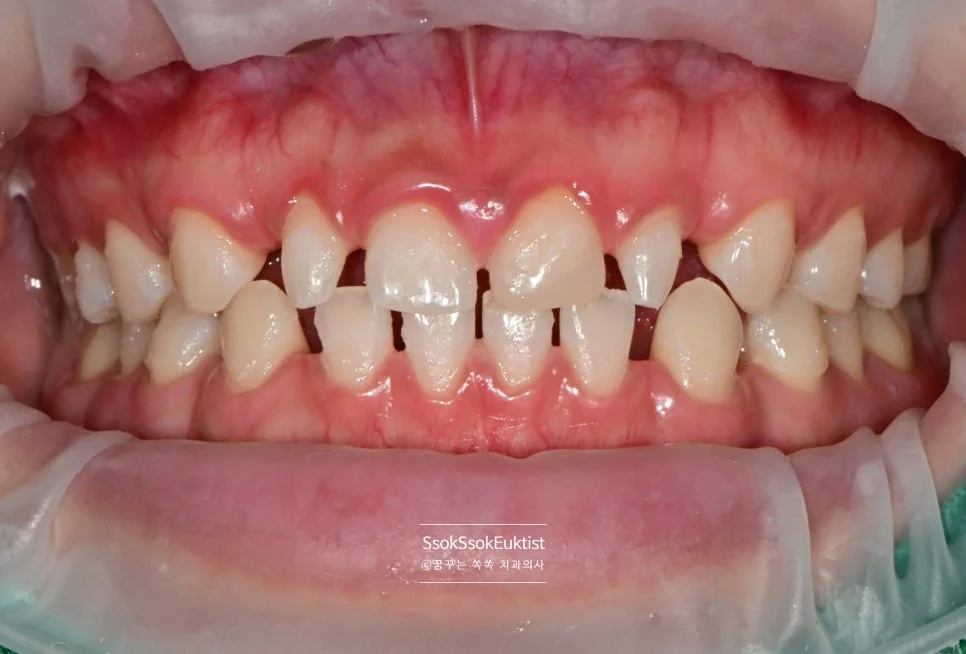 미백 후 A1보다 밝은 치아 색상