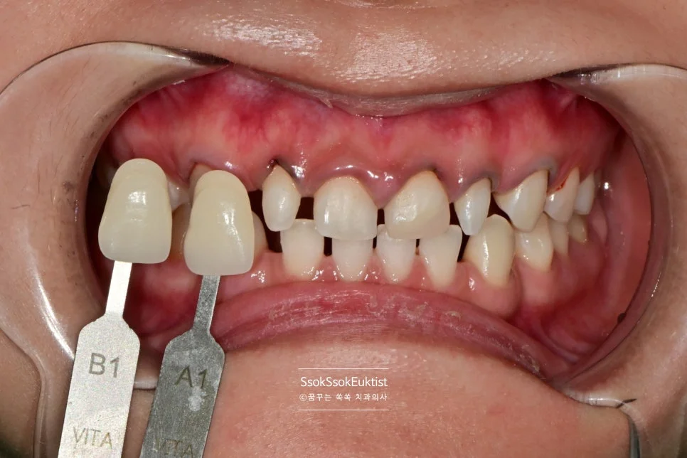 미백 후 측면 밝은 치아 사진