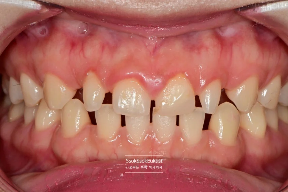 미백 전 A2보다 어두운 치아 색상