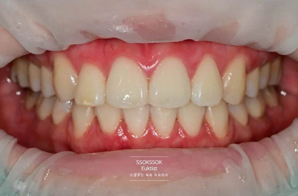 원데이 치아미백 케이스1 시술 후 정면 밝아진 치아