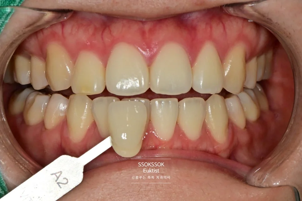 원데이 치아미백 케이스1 시술 전 근접 촬영