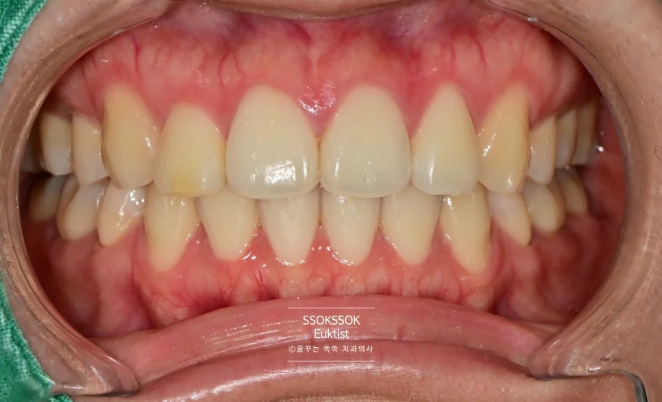원데이 치아미백 케이스1 시술 전 정면 치아 상태