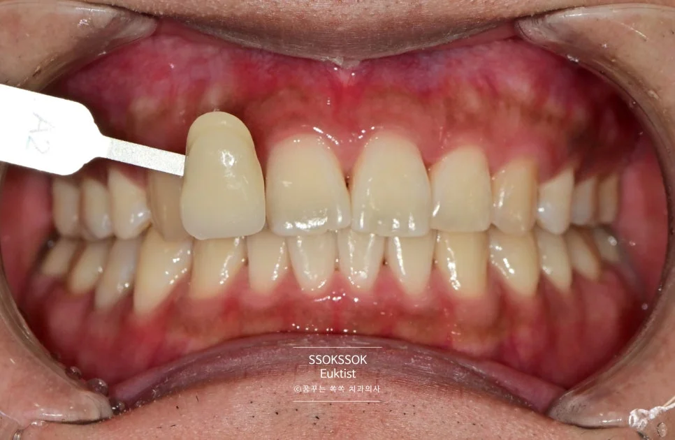 원데이 치아미백 케이스2 시술 후 근접 촬영