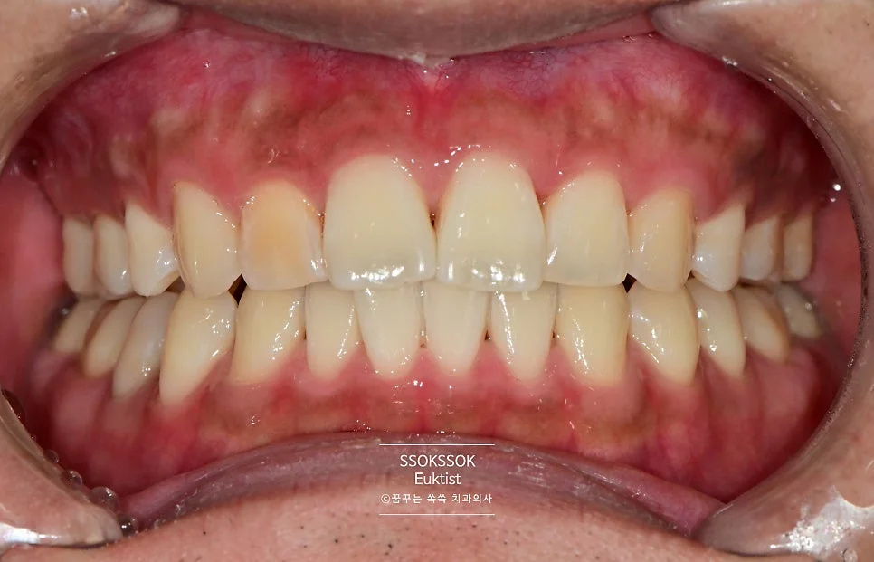 원데이 치아미백 케이스2 시술 후 밝아진 치아