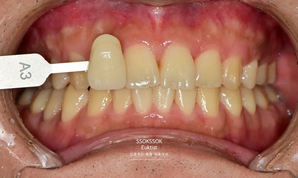원데이 치아미백 케이스2 시술 전 근접 촬영