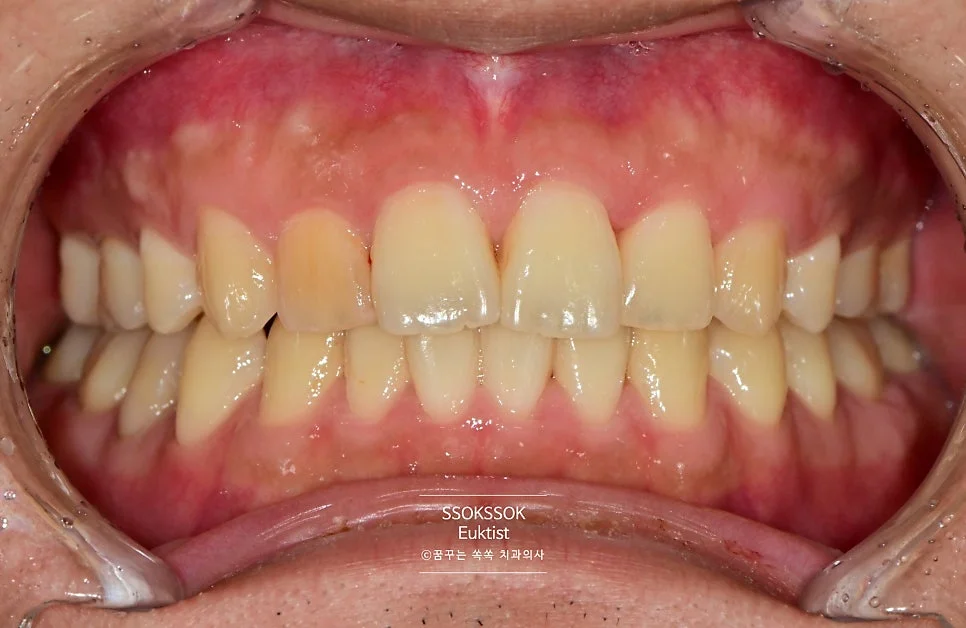 원데이 치아미백 케이스2 시술 전 정면 치아 상태