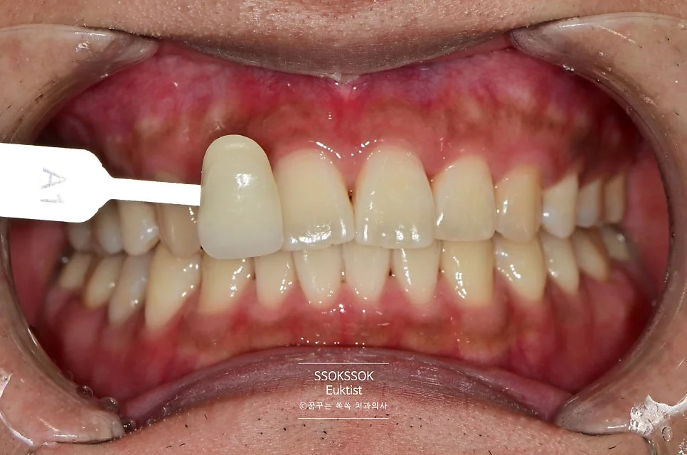 원데이 치아미백 케이스2 쉐이드 가이드 색상 비교