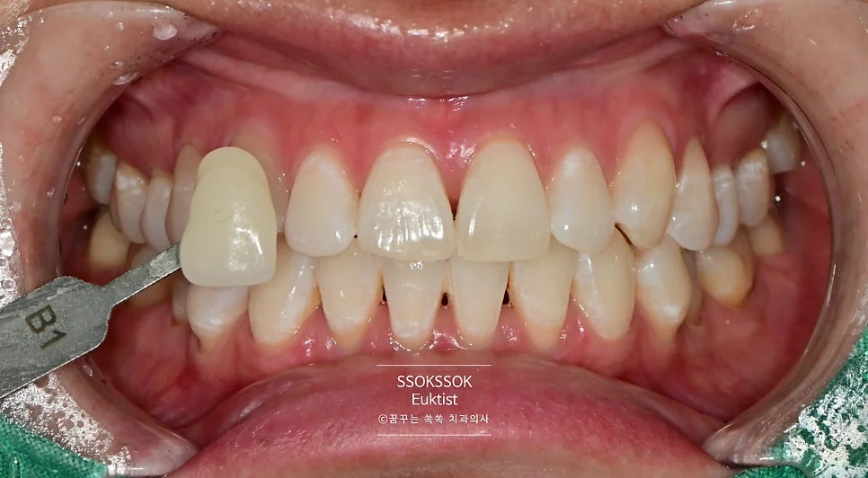 원데이 치아미백 케이스3 시술 후 근접 촬영