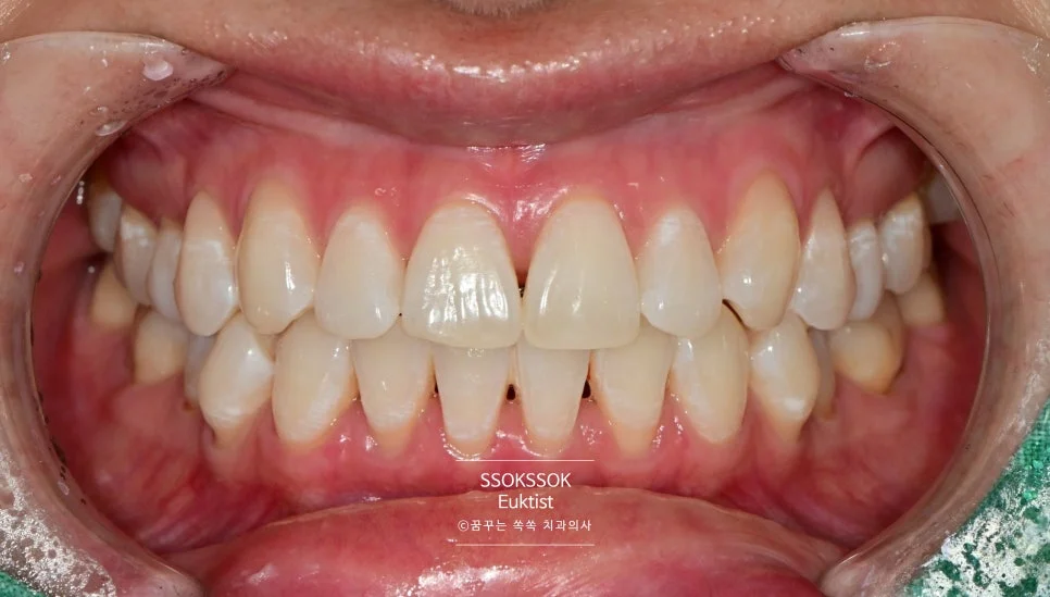 원데이 치아미백 케이스3 시술 후 밝아진 치아