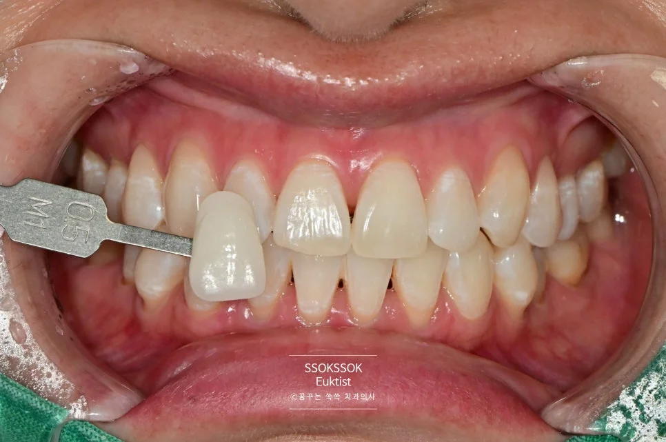 원데이 치아미백 케이스3 시술 후 미백 쉐이드 가이드 M1 비교