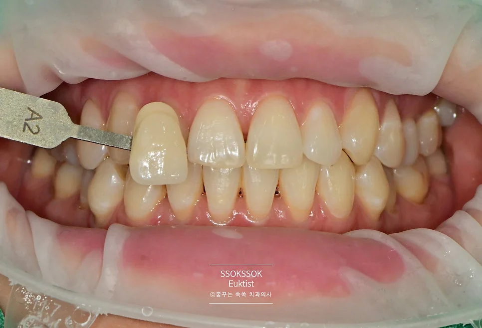 원데이 치아미백 케이스3 시술 전 근접 촬영