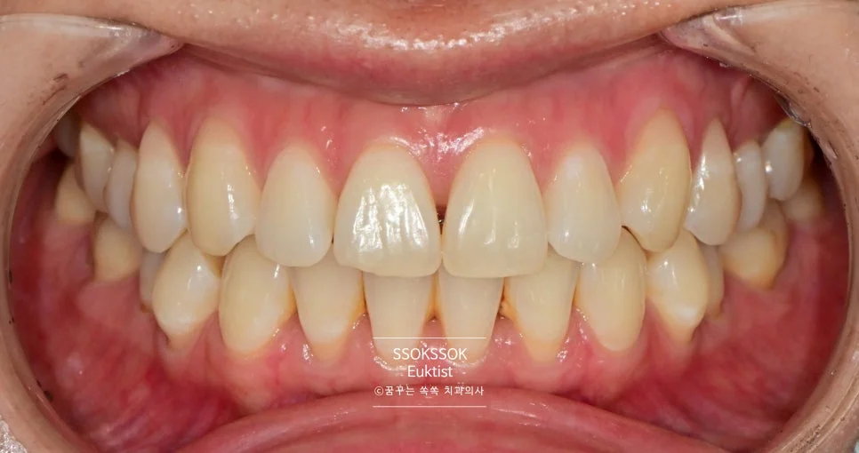 원데이 치아미백 케이스3 시술 전 정면 치아 상태