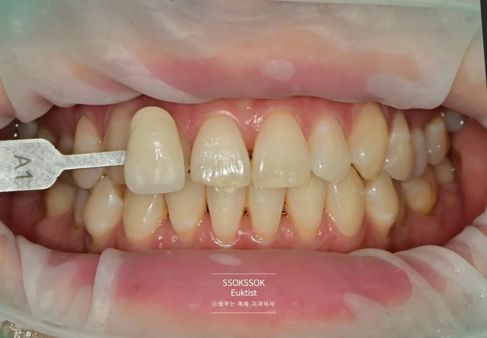 원데이 치아미백 케이스3 시술 전 쉐이드 가이드 비교