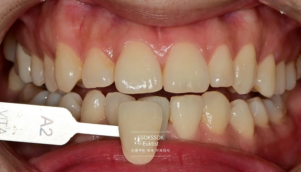원데이 치아미백 케이스4 시술 전 근접 촬영