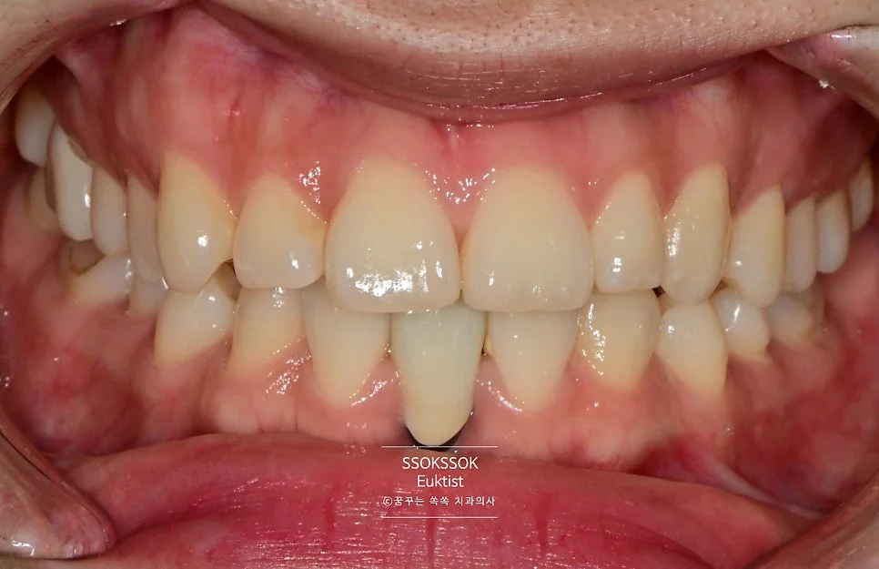 원데이 치아미백 케이스4 시술 전 정면 치아 상태