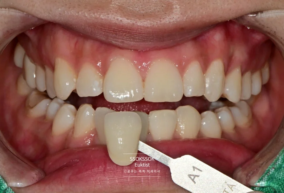 원데이 치아미백 케이스4 1차 방문 미백 후 근접