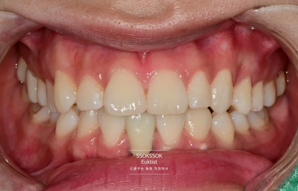 원데이 치아미백 케이스4 1차 방문 미백 후 정면