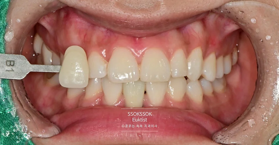 원데이 치아미백 케이스4 최종 미백 후 근접