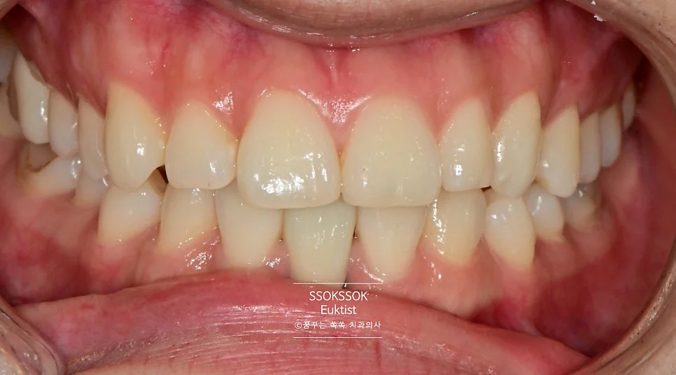 원데이 치아미백 케이스4 2차 방문 전 정면