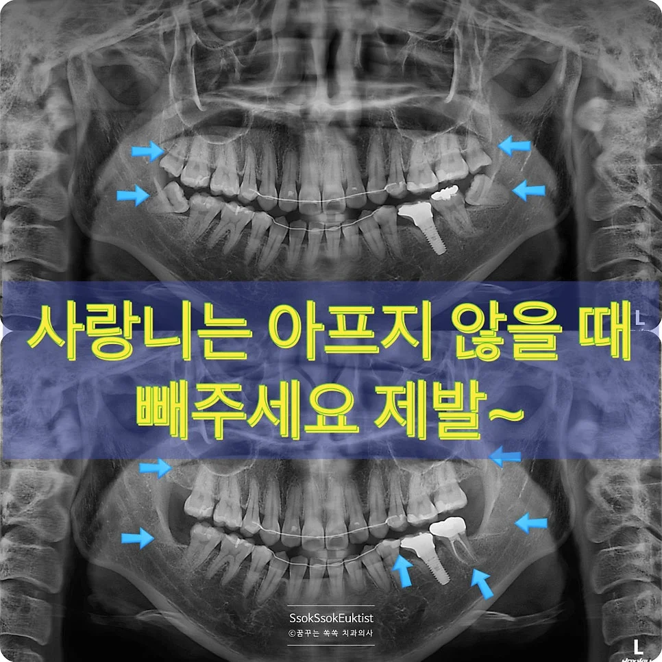 사랑니 발치 및 앞어금니 치료 소개 사진