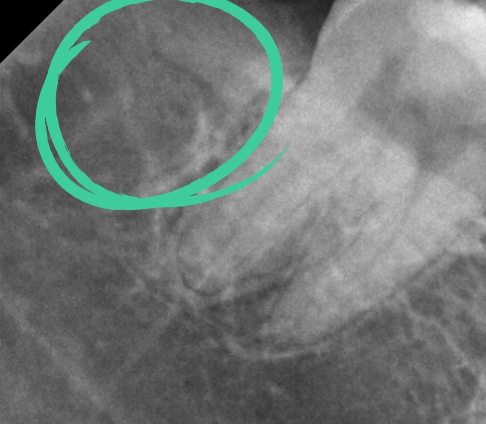 케이스1 우측 매복 사랑니 발치 후 모습