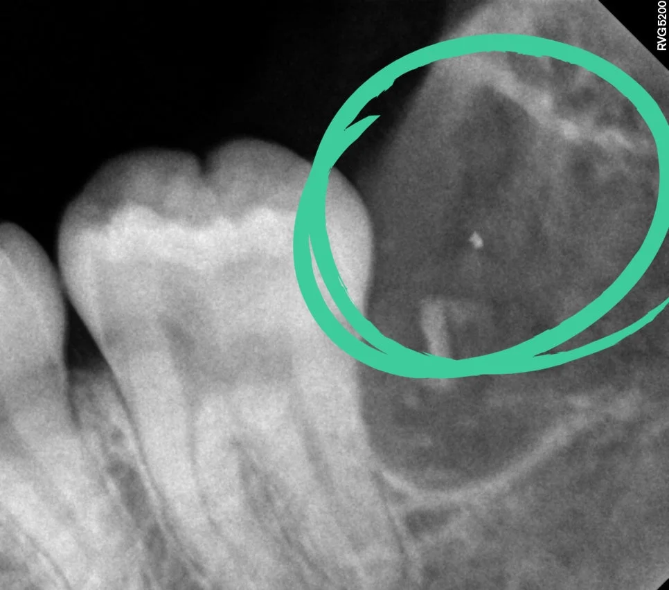 케이스1 좌측 매복 사랑니 발치 후 모습