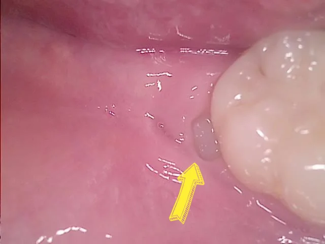 매복 사랑니 우측 구내 잇몸 아래 매복 상태