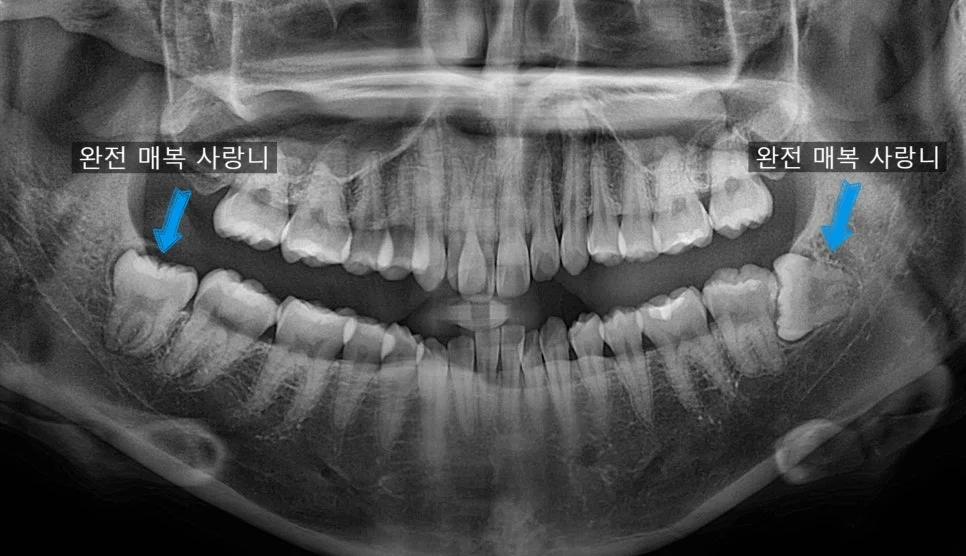 매복 사랑니 양쪽 파노라마 진단