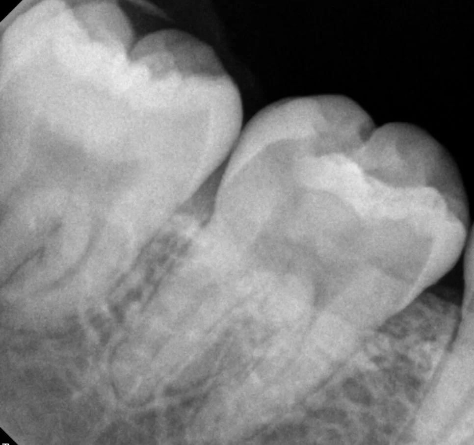 매복 사랑니 우측 치근단 X-ray 수평 매복