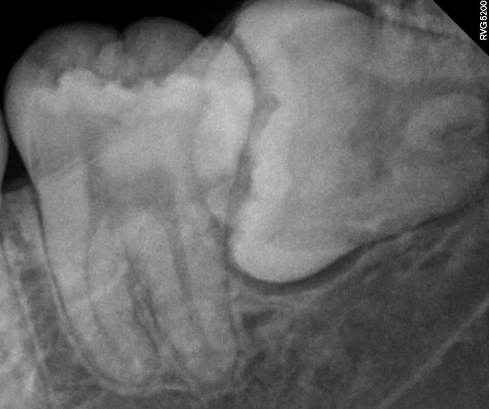 매복 사랑니 좌측 치근단 X-ray