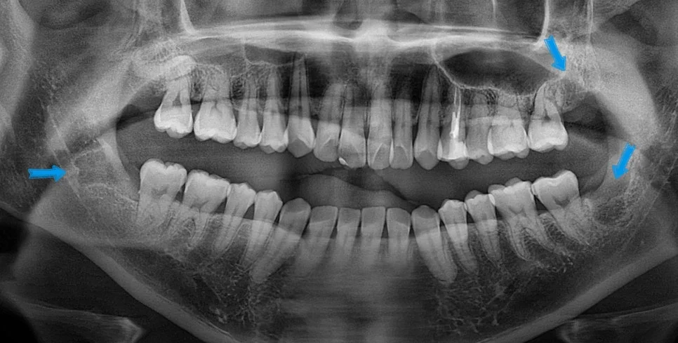 케이스2 사랑니 3개 동시 발치 결과