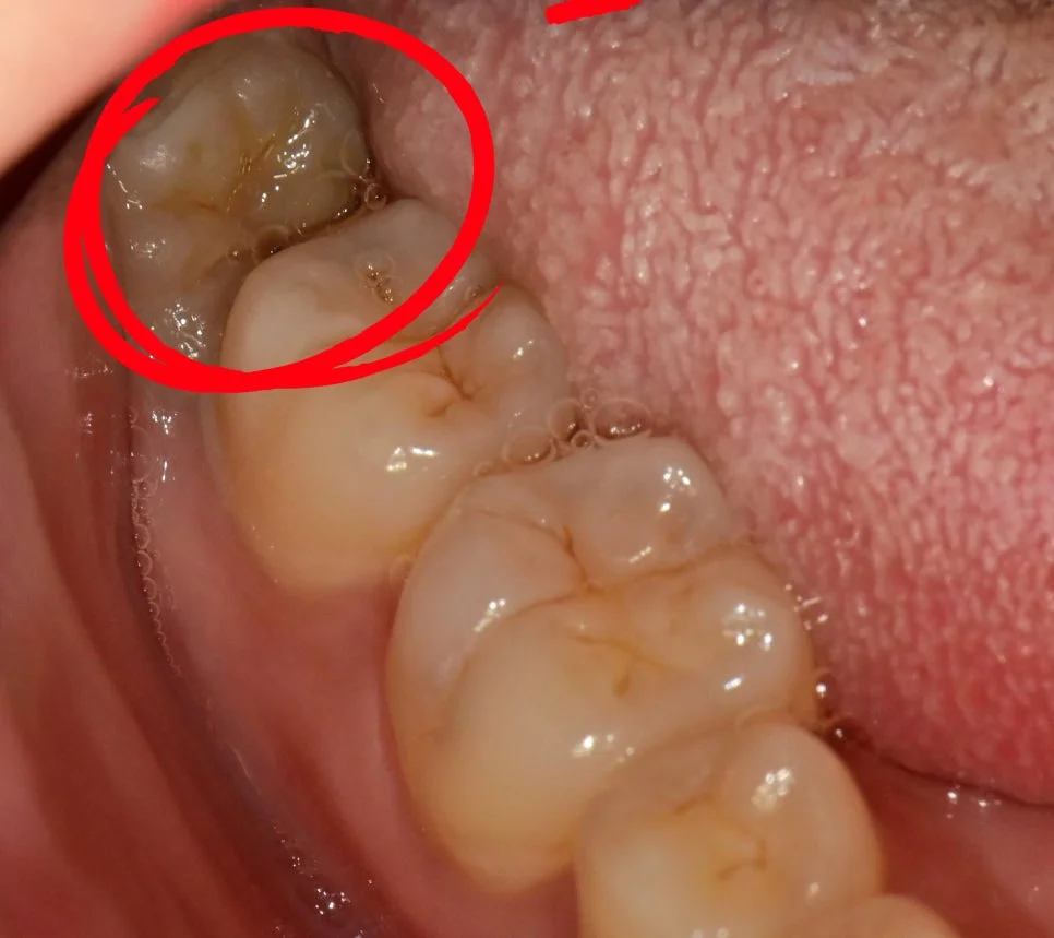 케이스2 좌측 사랑니 상태 파노라마