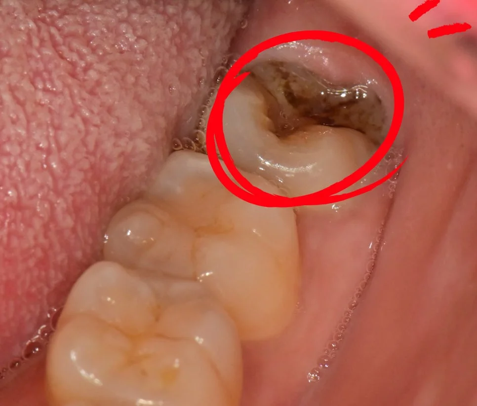 케이스2 우측 사랑니 충치 파노라마