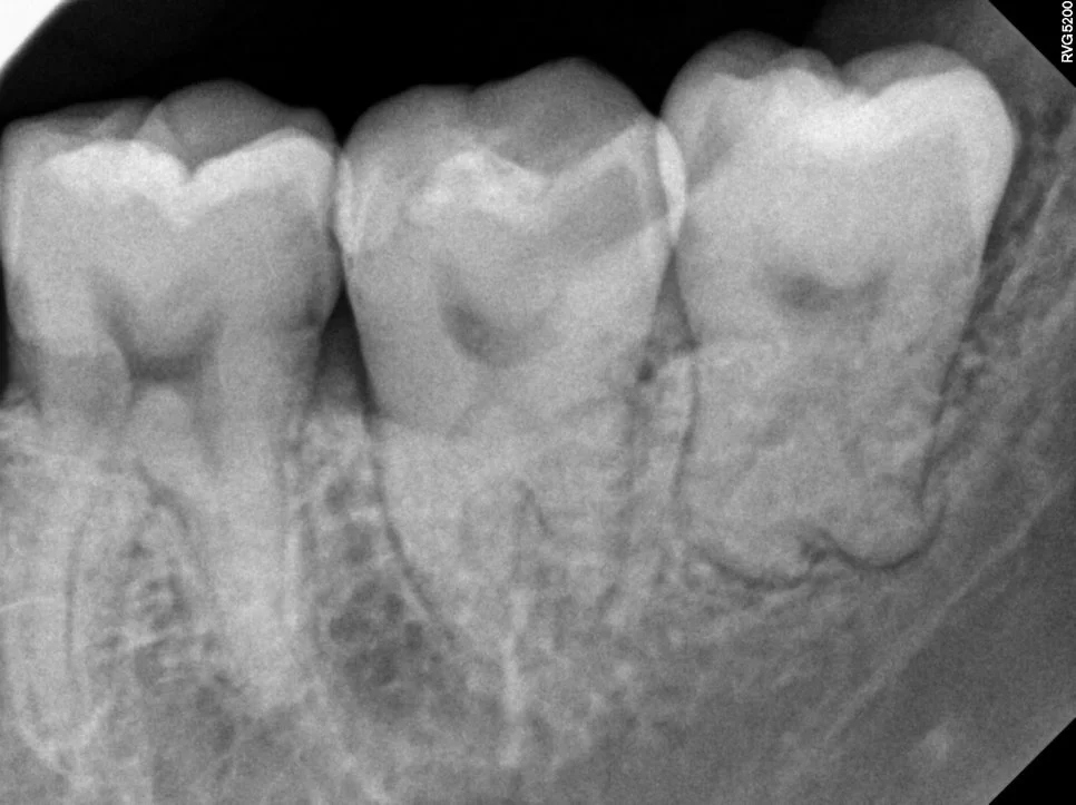 케이스2 좌측 하악 사랑니 충치 위험