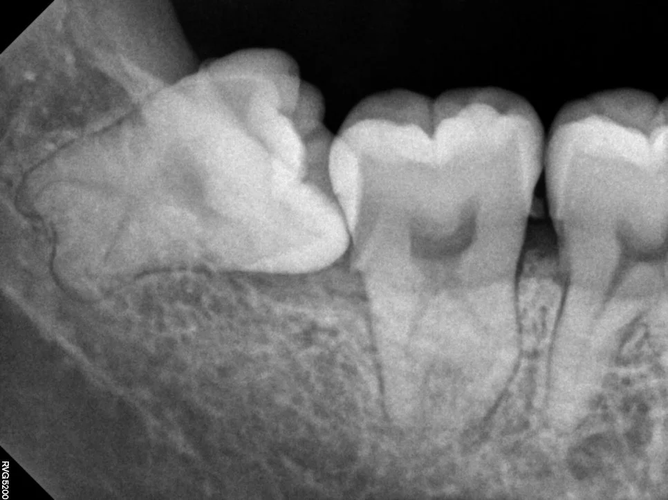 케이스2 우측 매복 사랑니 제2대구치 위협