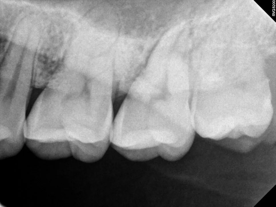 케이스2 좌측 상악 사랑니 관리 어려운 상태