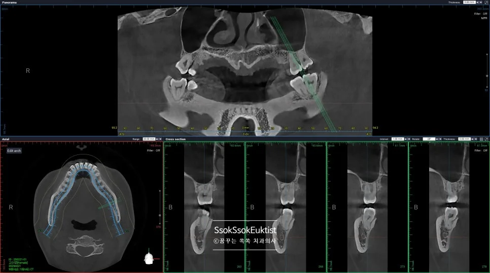 CBCT 좌측 하악 매복 사랑니 신경관 근접도 분석