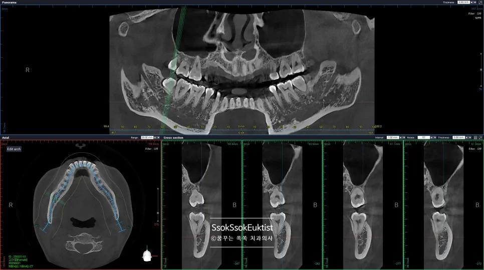 CBCT 우측 하악 매복 사랑니 신경관 근접도 분석