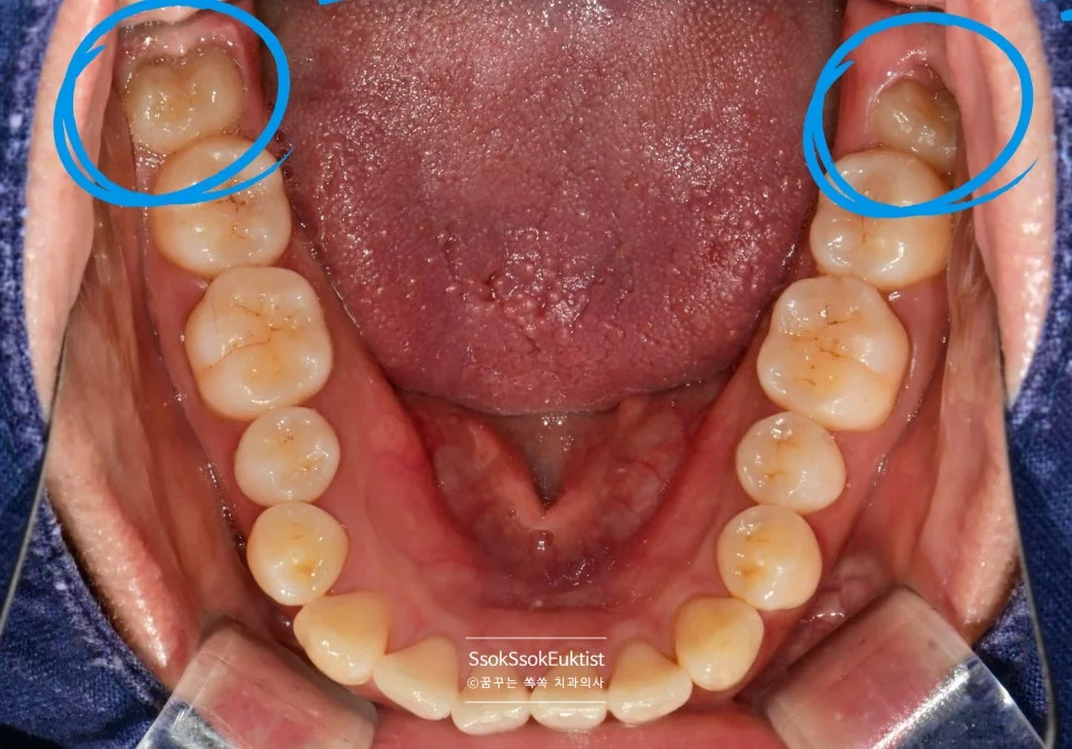 하악 교합면 구내사진 양쪽 매복 사랑니 파란 원 표시