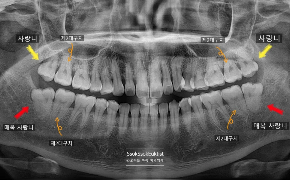 사랑니 4개 파노라마 상악 하악 매복 사랑니 제2대구치 표시