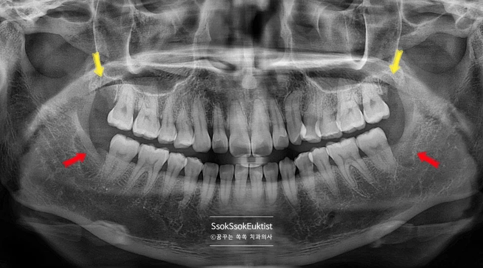 사랑니 4개 발치 계획 파노라마 상악 하악 화살표 표시