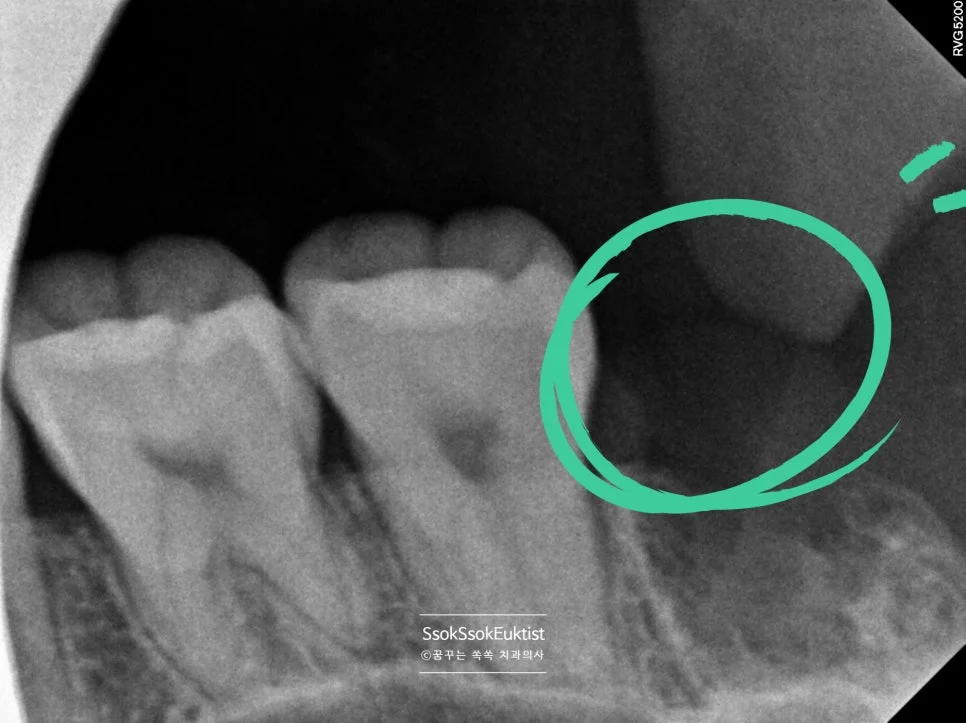 사랑니 발치 후 좌측 하악 치근단 X-ray 초록 원 표시