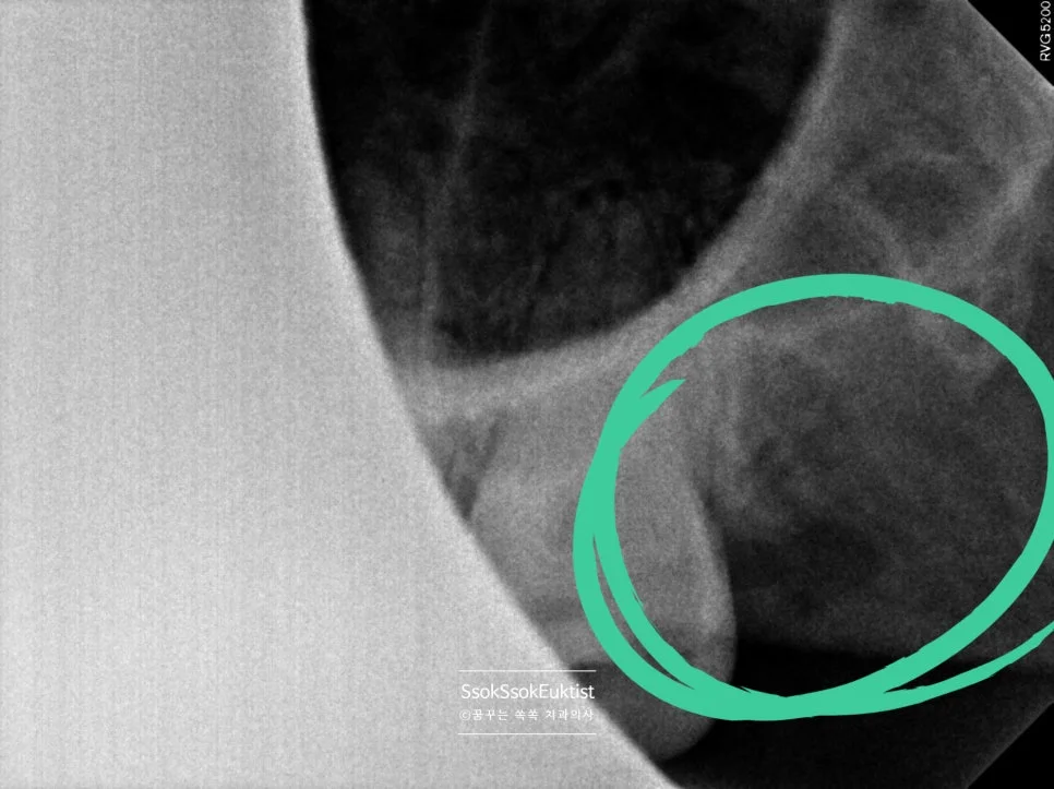 사랑니 발치 후 우측 하악 치근단 X-ray 초록 원 표시