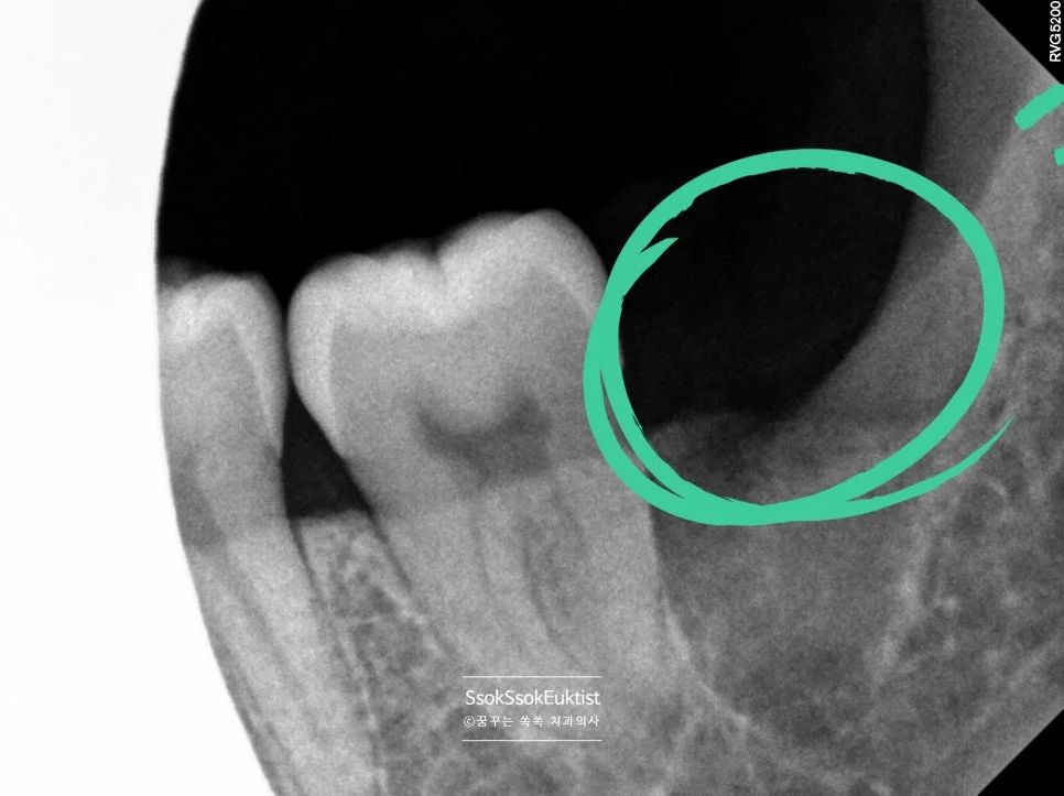 사랑니 발치 후 좌측 상악 치근단 X-ray 초록 원 표시