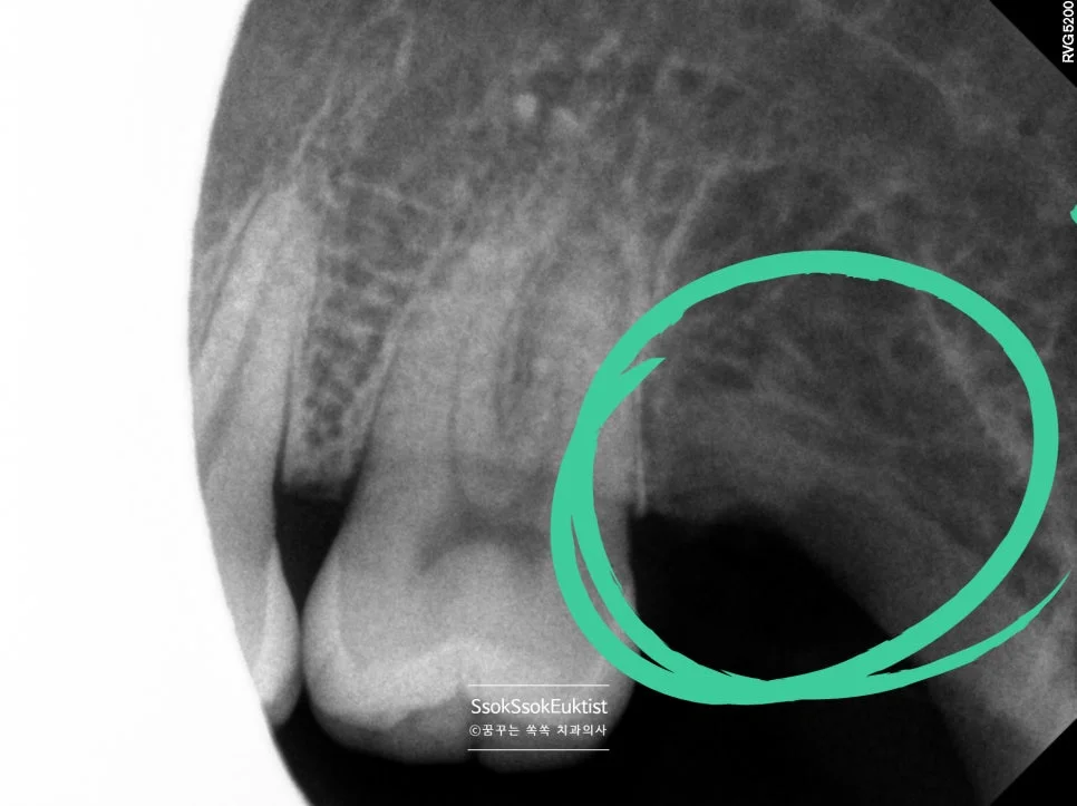 사랑니 발치 후 우측 상악 치근단 X-ray 초록 원 표시