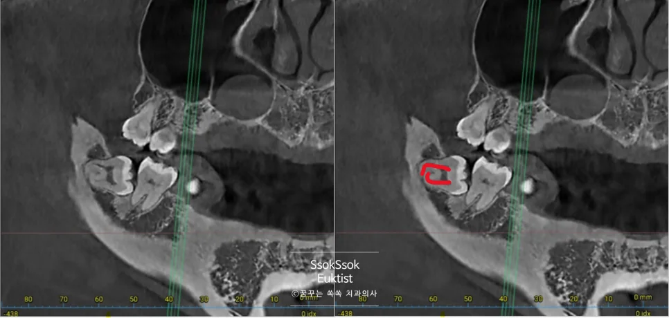 사랑니 뿌리 해부학적 구조 일러스트