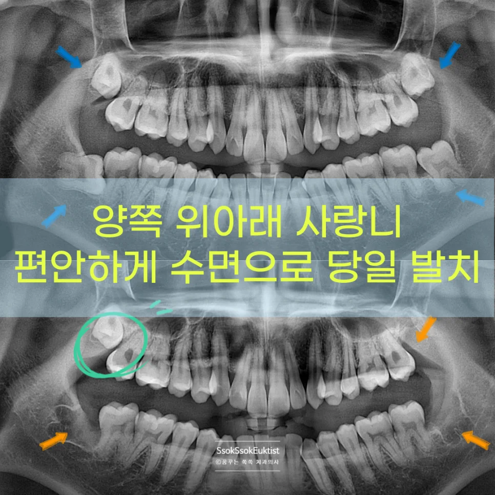 매복 사랑니 파노라마 엑스레이 위아래 사랑니 매복 상태